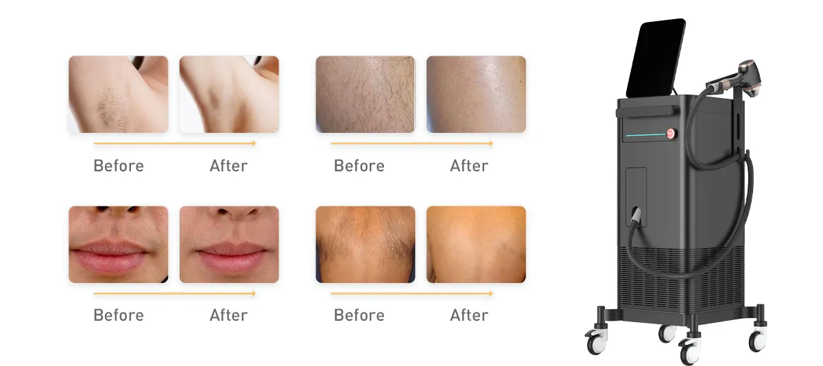 Come scegliere un fornitore affidabile di macchine per la depilazione Laser a diodi