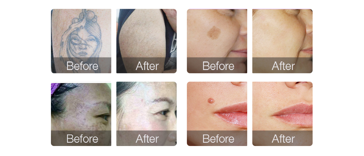 wholesale_picosecond_laser_tattoo_removal_machine.jpg